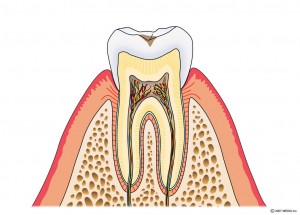 むし歯の進行　CO